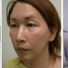 頬のたるみ　切る手術と切らない手術の組み合わせ　症例写真