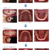 治療報告【 舌側矯正(見えない矯正)治療】