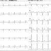 ECG-200：60才代男性。入院時心電図です。