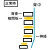 椎間板ヘルニア　エピソードⅠ「発症」