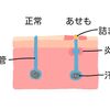 赤ちゃんの汗疹（あせも）対策とママのケア：夏の肌トラブルを防ぐ