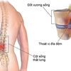 Bệnh thoát vị đĩa đệm thể trung tâm là gì ?