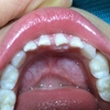乳歯の後ろから永久歯が生えてきた5歳半の息子