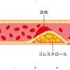 病気一つしない人ほど動脈硬化の理由