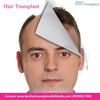 Hair Transplant Surgery – Is Hair Loss Worrying You?  Try this Surgical Procedure!