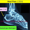 What Causes Heel Spur