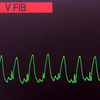 ECG-222：90才代女性。(ECG-221の12誘導心電図は？)