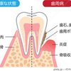 ●歯垢と歯石2●