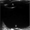 case137：ウエイトリフティング後に霧視と飛蚊症を発症した30歳男性（Ann Emerg Med. 2021 Feb;77(2):269-283.）