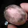 円形脱毛症の治療：4度目の受診
