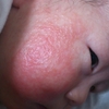 乳児湿疹