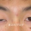 右目がひらかない。先天性眼瞼下垂症に対する筋膜移植術  10代男性