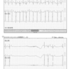 長い洞停止で終わる発作性心房細動PAfがありました（前回の続き）