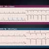 ECG-177：answer