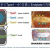 なぜ、椎体骨折なのに鼠径部や腹部、臀部が痛くなるのか？