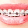 Điều trị hô móm bằng niềng răng mắc cài