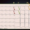 ECG-182：answer