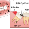 奥、奥、奥〜の歯、親知らずについて🦷