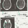 脳腫瘍・悪性リンパ腫治療記（20）「血液内科にて化学療法(3)」事前準備と画像診断