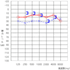 左耳手術から半年後の診察