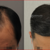 FUE 3500株植毛 ビフォーアフター動画です☆