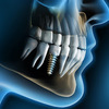 Trồng răng implant cần lưu ý những gì?