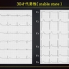 ECG-311：30才代男性です。動悸とめまいで、立てなくなります。