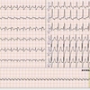 ECG-277：80才代男性。腹痛と胸部不快です。