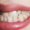 【歯医者怖い系の歯医者ルポ】歯列矯正をせずに歯列を整える方法と実践中レポート