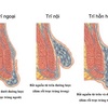 Những sự thật về căn bệnh trĩ