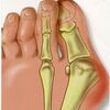 Bunions Causes Symptoms And Treatments