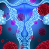 WHAT ARE UTERINE FIBROIDS