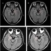 扁桃体腫大を伴う側頭葉てんかん：病態・診断・治療の最新知見