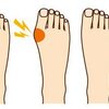 Hallux Valgus Symptoms