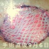 DFSP闘病生活回顧録（29）