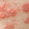 帯状疱疹後の消えない痛みに役立つ方法5選