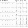 ECG-120：60歳男性。呼吸苦で、来院されました。