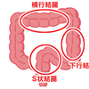 腸がつまりやすい人は落下腸かねじれ腸？便秘や腸閉塞になりやすい。