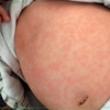 1歳(12か月)で突発性発疹にかかる・・・