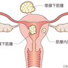 子宮筋腫の女性へ