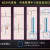 ECG-295：answer