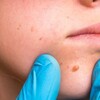 How to Remove Skin Tags, Depending On to Dermatologists