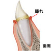 歯周病とは？