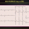 ECG：80才代男性。深夜の胸部不快感でした。