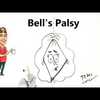 Bell's Palsy Explained Simply