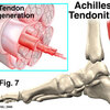 What's The Main Cause Of Achilles Tendon Pain ?