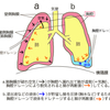 胸腔ドレーン看護管理⑴看護師がチェックすべき９項目【適応・目的・挿入部位】