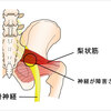 梨状筋と坐骨神経痛の関係。