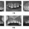 0歳児のお母様からの質問「上の歯と歯の間があいています。将来の歯並びが心配です」～上唇小帯付着位置異常について