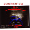 Ｑが嚢胞性卵巣疾患と診断されたのは